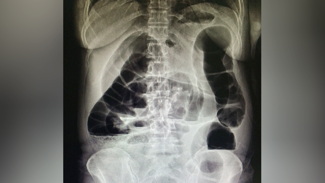 อย่าชะล่าใจ เตือนคนท้องผูกเรื้อรังจนลำไส้อุดตัน ต้องตัดทิ้งแล้วต่อใหม่