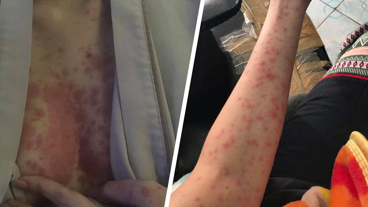 เข้ากะ นอนน้อย รู้จักโรคคนทำงาน หลังสาวสวยตุ่มคันขึ้นทั่วร่าง แพทย์แนะทางป้อง