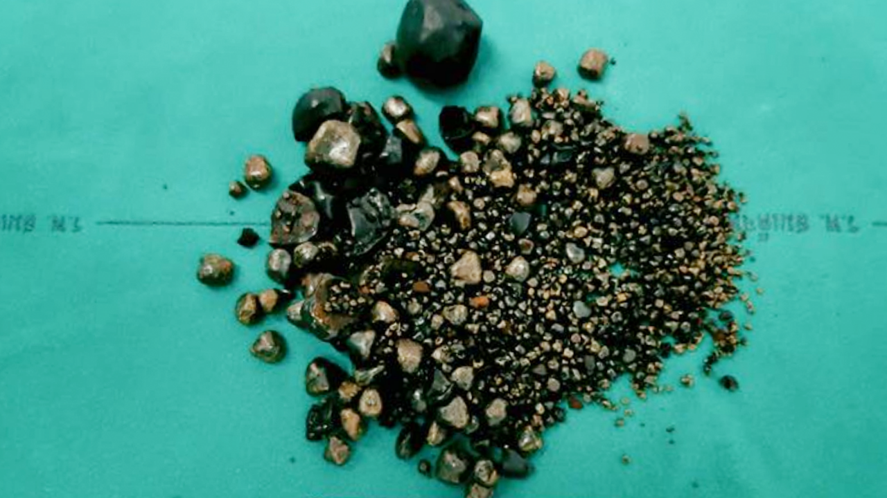 "นิ่ว" เองจ้า ไม่ใช่หิน อยู่ในถุงน้ำดี หมอผ่าส่องกล้อง นับได้ 1,898 เม็ด