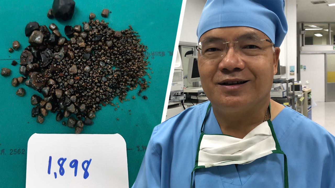 ผ่ามา 25 ปี ก็เพิ่งเคยเห็น เปิดใจ "หมอวัฒนา" มือพิฆาตนิ่ว 1,898 เม็ด 