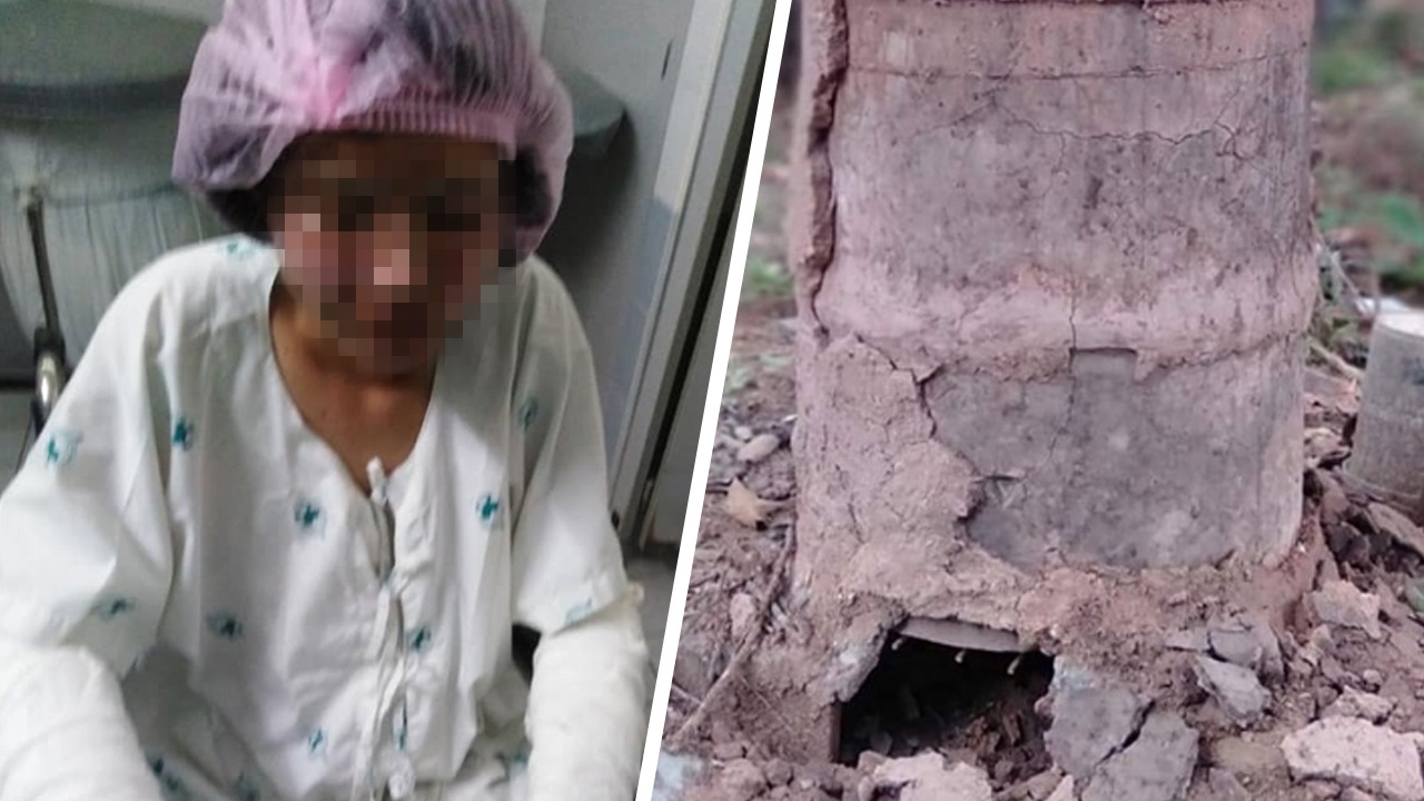 นร.หญิงเผาถ่านแลกคะแนน ถูกไฟลวกทั้งตัว อ้างครูปัดรับผิดชอบ ไล่ไปฟ้องเอา