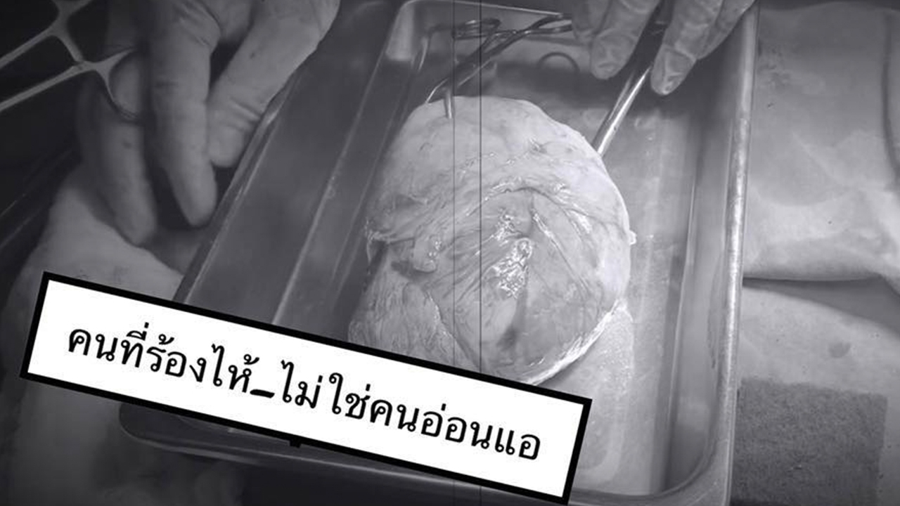 สาวท้องป่อง ประจำเดือนมามาก ปวดจนเป็นลม สุดท้ายเจอเนื้องอกที่มดลูก 12 ซม.
