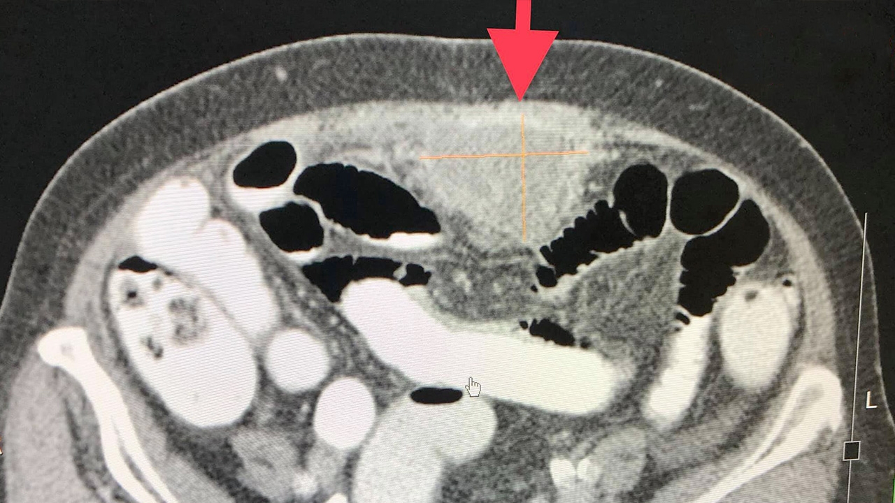 เตือนภัยใกล้ตัว หญิงปวดท้อง คลำเจอก้อนแข็ง พบ "มะเร็งเยื่อบุช่องท้อง"