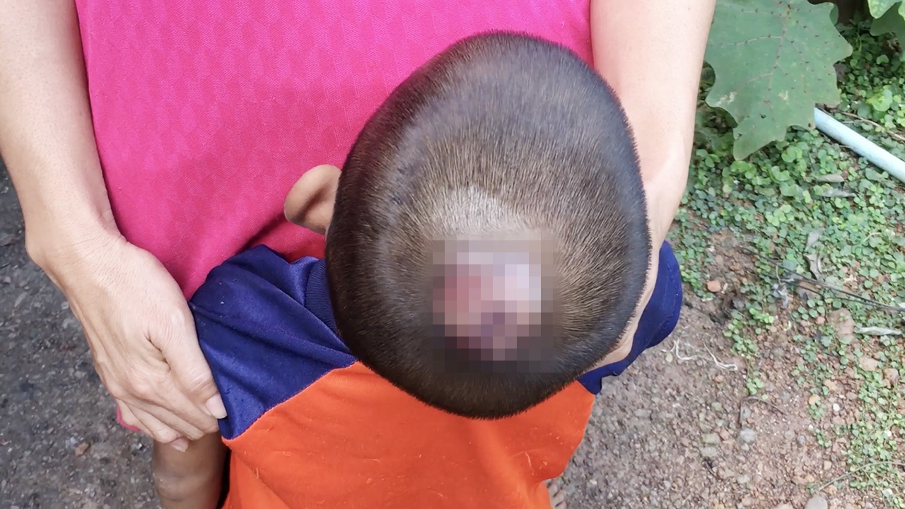 แห่ช่วย 4 ขวบล้มเป็นแผลกลางหัว ลามวงกว้าง บ้านยากจนไม่มีเงินพาไปรักษา