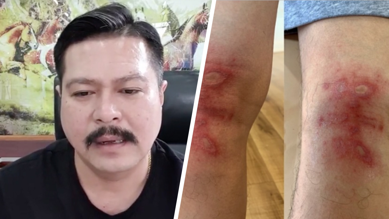 "วัน อยู่บำรุง" ถูกพิษ "แมลงก้นกระดก" เป็นแผลใหญ่ที่ขา 