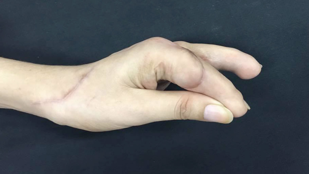 หมอไทยเจ๋ง ช่วยสาวนิ้วขาด 4 นิ้ว ผ่าตัดต่อให้ใหม่ ทีเดียว 2 นิ้วรวด