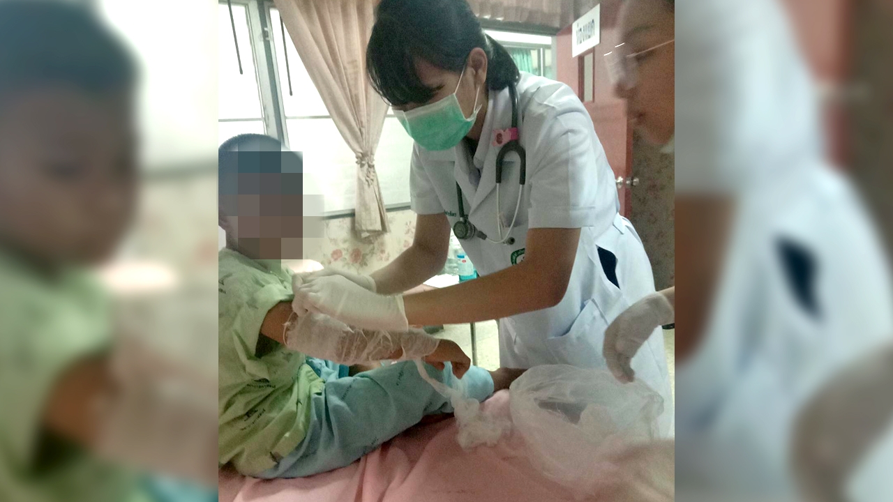 แม่ร้อง อดีต ผอ. ใช้ลูก 10 ขวบ ยกถังยางมะตอย พลาดลวกแขนผิวหลุด นิ้วหงิก