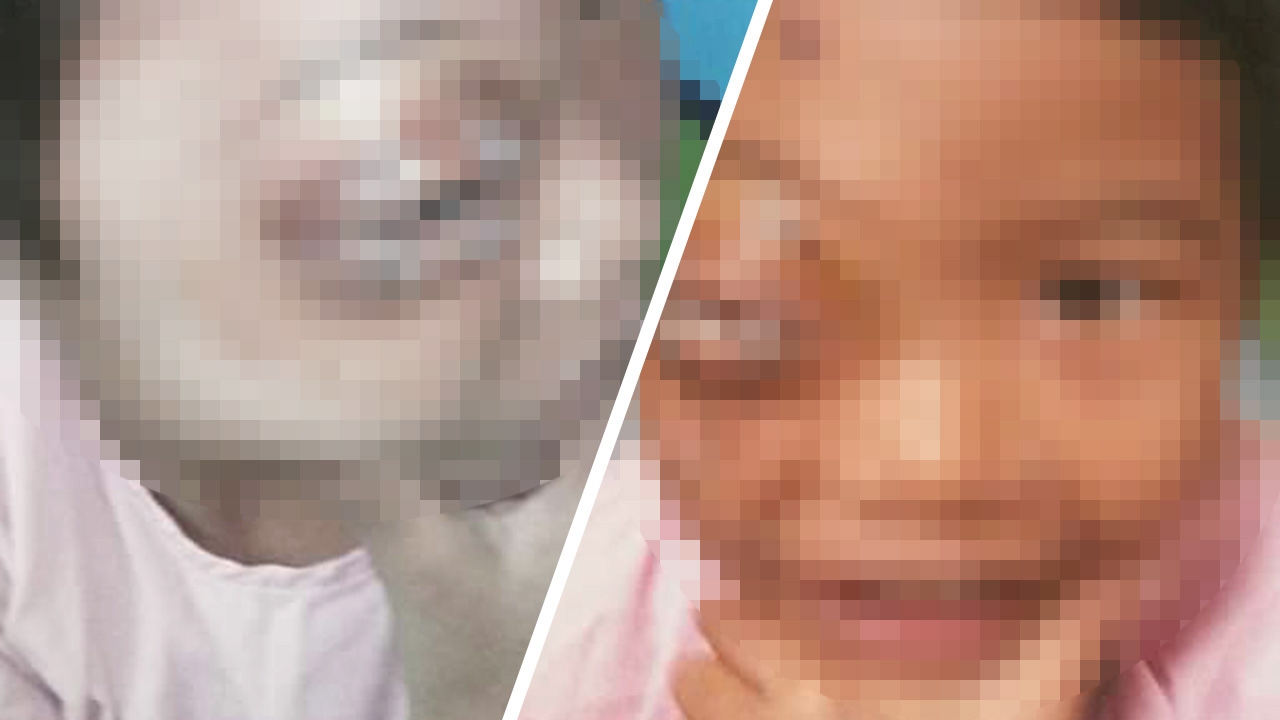 "น้องไนท์" เด็ก 5 ขวบ ป่วยลูกตาโปนมานอกเบ้าตา ฐานะยากจนไม่มีเงินรักษา