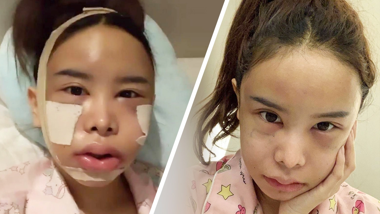 เปิดหน้าใหม่ มิ้ง โป๊ะแตก หลังศัลยกรรมทำสวยที่เกาหลี จำแทบไม่ได้