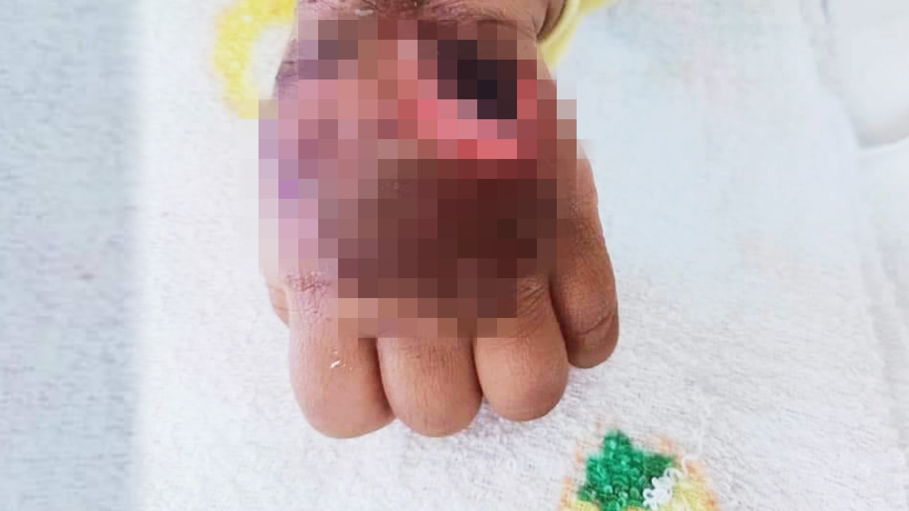 รพ.แจงเคส เข็มน้ำเกลือรั่ว เด็ก 10 เดือน แขนบวม ถุงน้ำแตกเป็นแผล