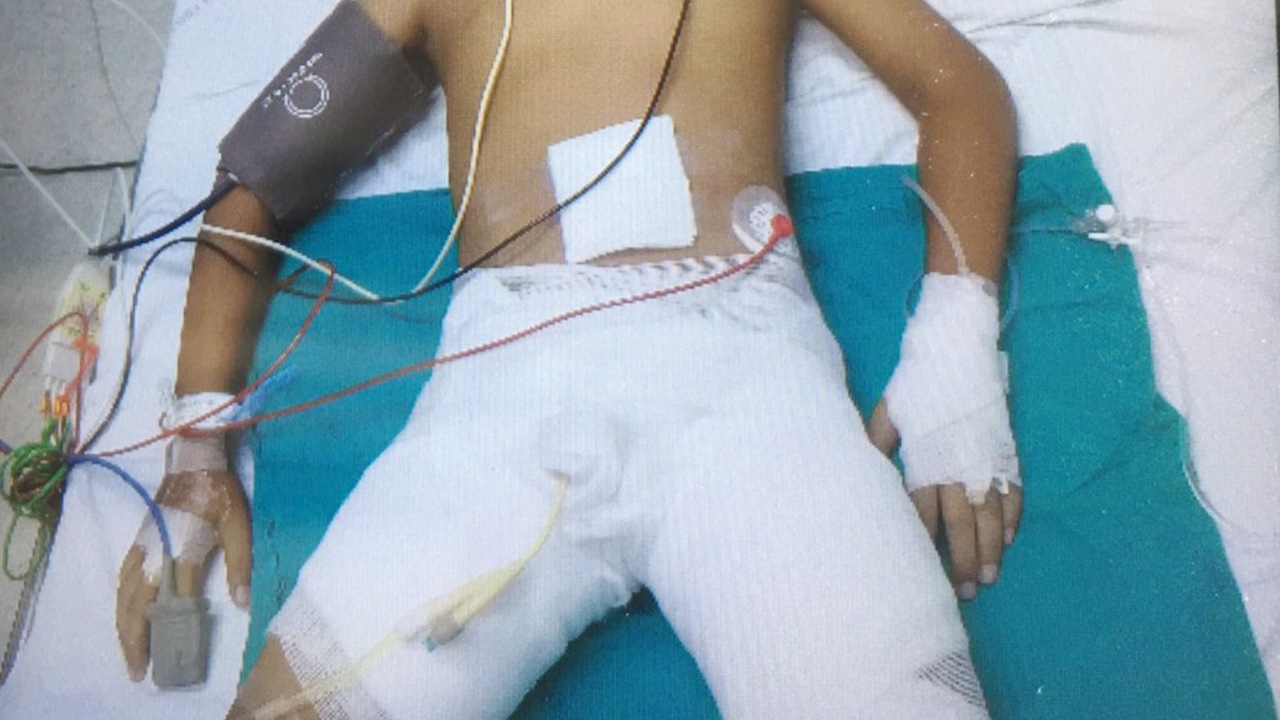 เด็ก ป.2 ราดน้ำมันเบนซินใส่เด็กป.3 ก่อนจุดไฟแช็กเผาไข่ เจ็บสาหัส