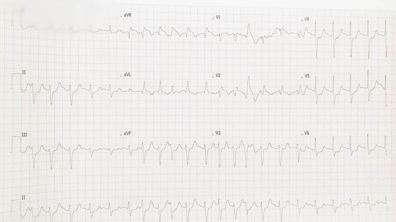 หมอเตือน ใจสั่น หัวใจเต้นผิดจังหวะ อย่านิ่งนอนใจ เสี่ยง "โรคใหลตาย"