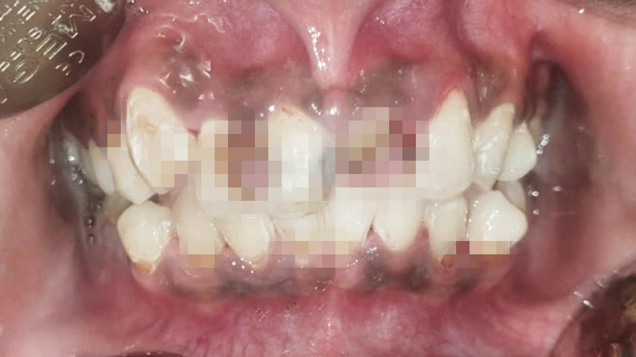 อุทาหรณ์ "จัดฟันแฟชั่น" ราคาถูกไม่คุ้มเสีย สภาพช่องปากพังพินาศ