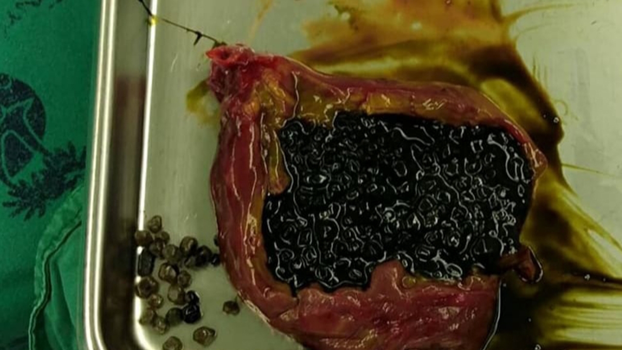 หมอพบ "นิ่วกรด" นับพันเม็ดอยู่ในถุงน้ำดี ผ่าออกมาดูเหมือน "ชาไข่มุก"