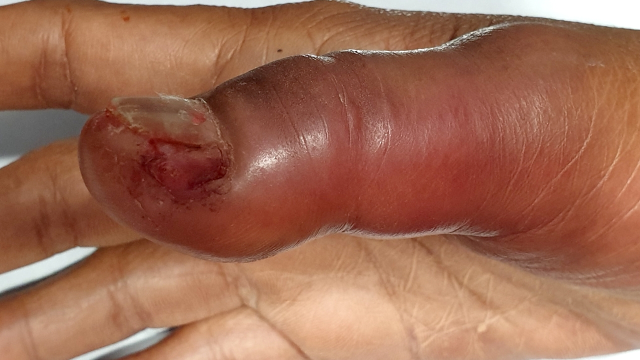 เตือนภัยสาวชอบทำเล็บ ระวังติดเชื้อไม่รู้ตัว หมอแนะควรเน้นความสะอาดร้าน