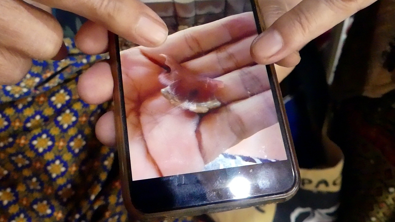 ยาย 76 ดีใจได้ฟันปลอมคืน เจออยู่ในลำไส้ ไม่รู้กลืนลงไปตอนไหน