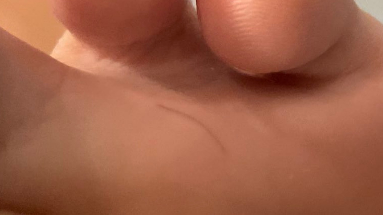 สาวแชร์ประสบการณ์ เส้นผมแทงเข้าผิวหนัง เริ่มอักเสบ เสี่ยงติดเชื้อ