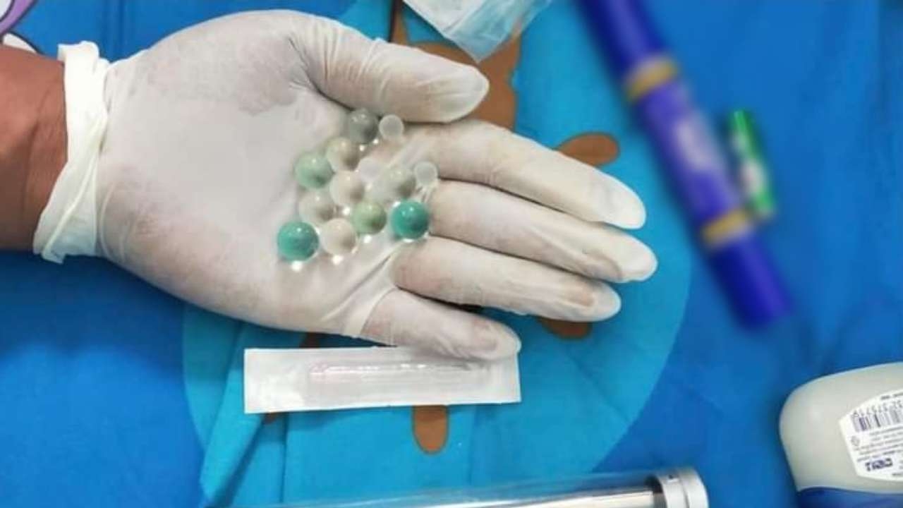 เตือนคลินิกเถื่อน "รับโมเจ้าโลก" ฝังมุก-เพิ่มขนาด เสี่ยงเน่า ติดเชื้อ