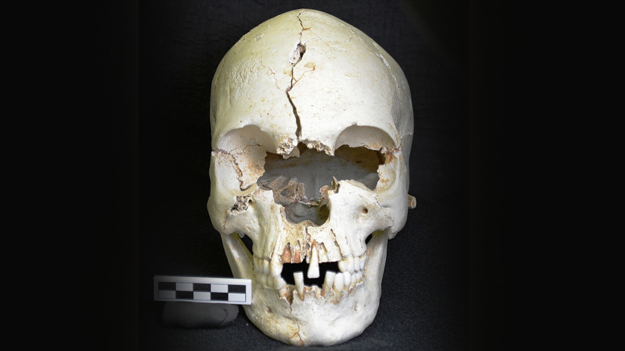 กะโหลกบนเกาะในแคริบเบียน ให้หลักฐานโรคเรื้อน