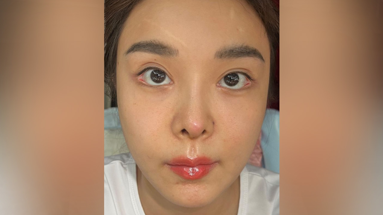 เปิดภาพ หญิงแย้ สูตรดั้งเดิม เผยปมต้องถอดซิลิโคน อุทาหรณ์คนเสริมจมูก 