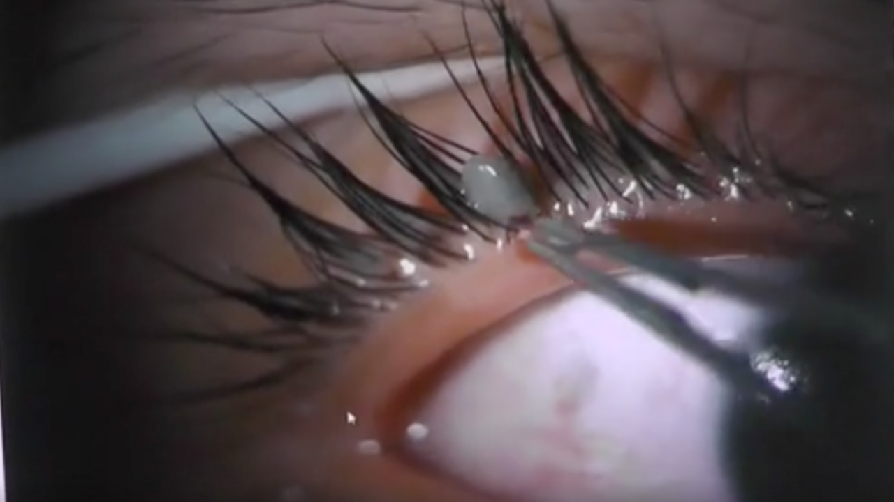 หมอคนโพสต์ คีบเห็บหมาจากเปลือกตาเด็ก เตือน ห้ามเอาออกเอง 