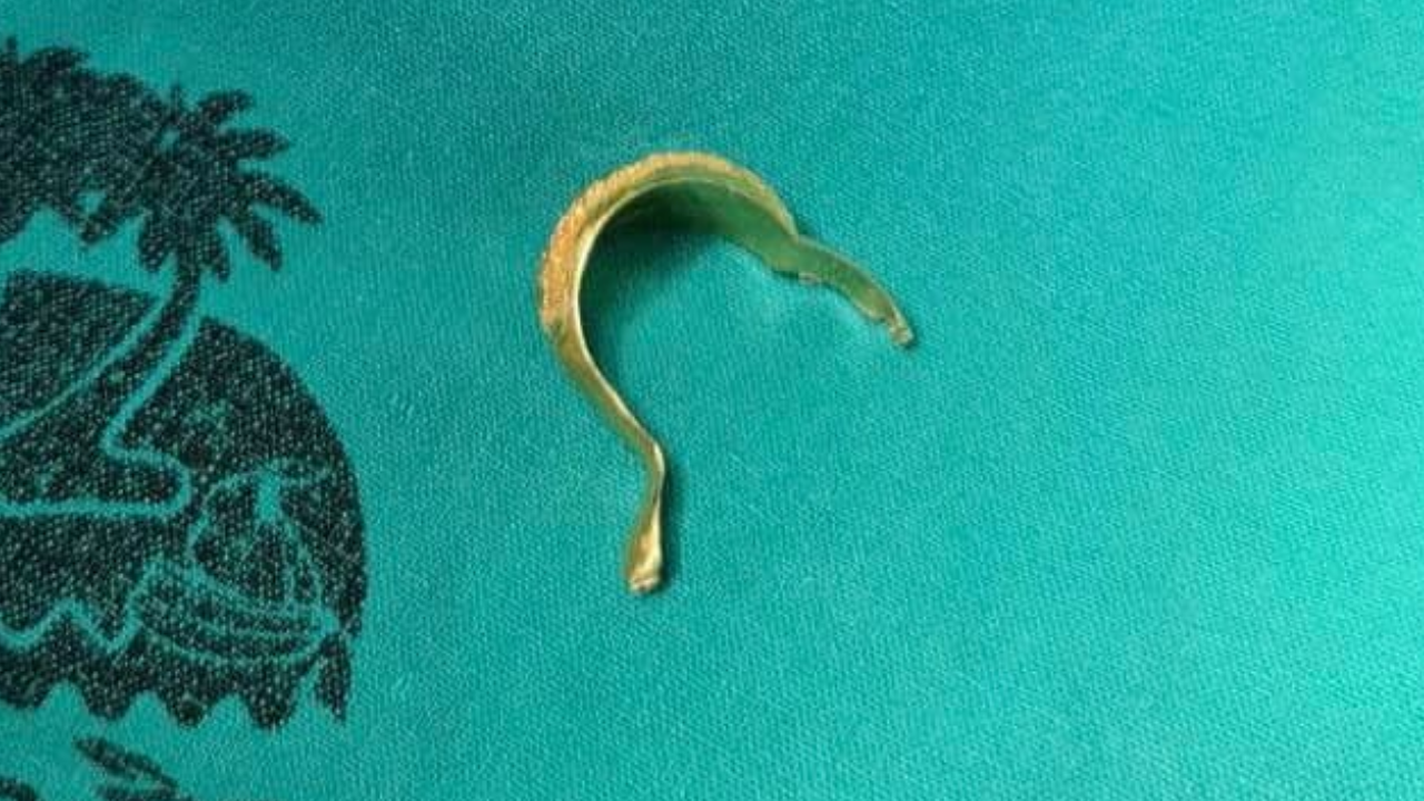 อุทาหรณ์ สวมแหวนทองรับขวัญหลาน 3 ขวบ ถอดไม่ออก เสี่ยงนิ้วเน่าต้องตัดทิ้ง