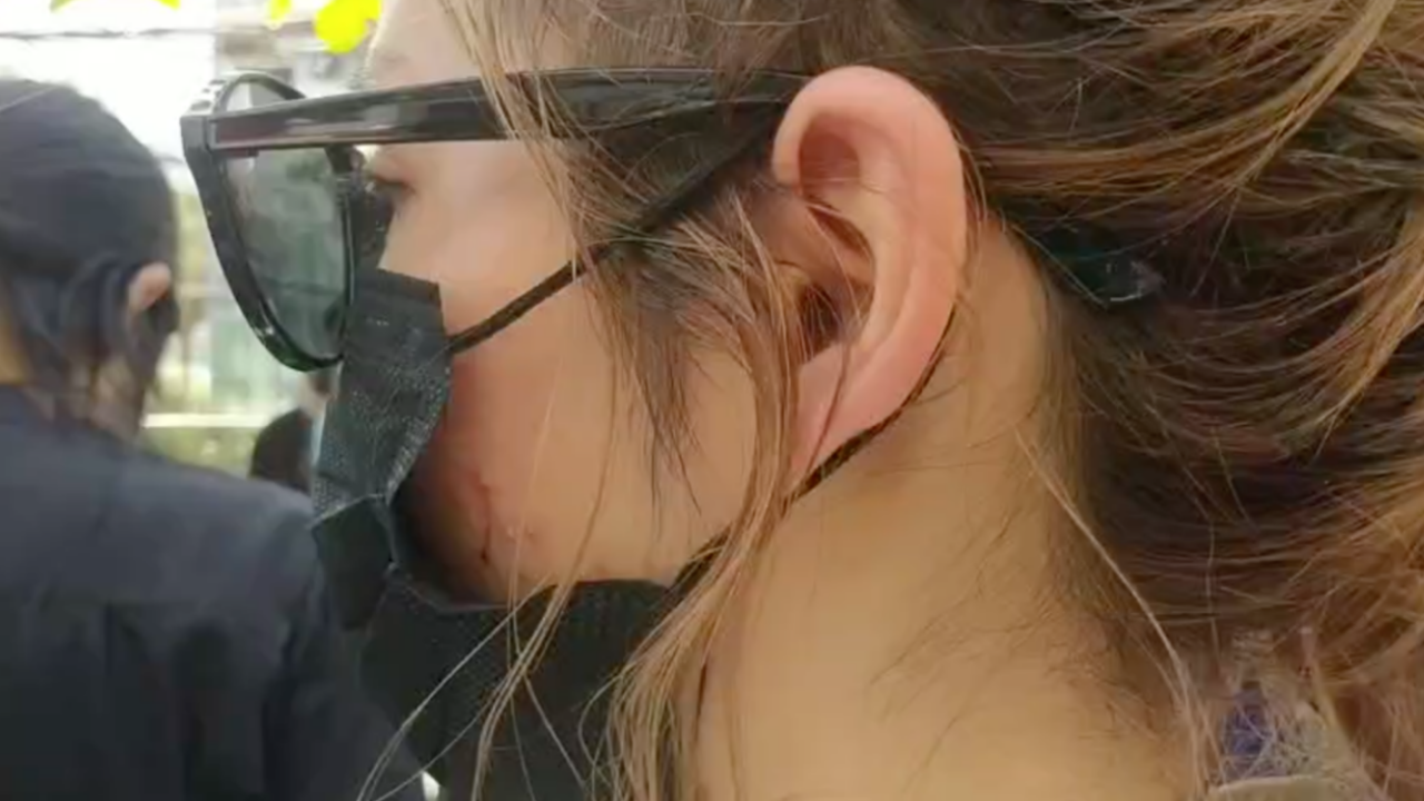 "โนอา" นำหลักฐานมอบ ตร. ยันถูกจิกหัวข่วนหน้าเป็นแผล เสียหายนับล้าน