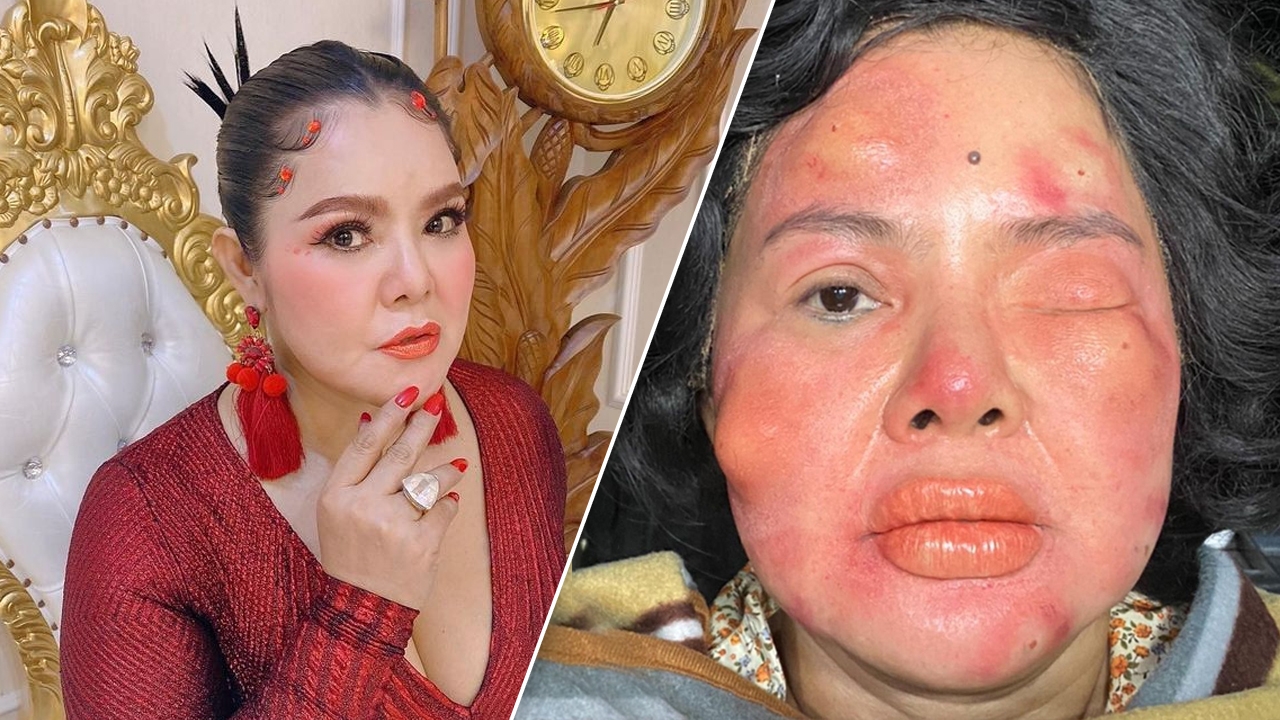 ฮาย อาภาพร โพสต์ภาพหน้าบวมปูดกลางดึก แฟนๆ ตกใจเรื่องจริงหรือถ่ายหนัง