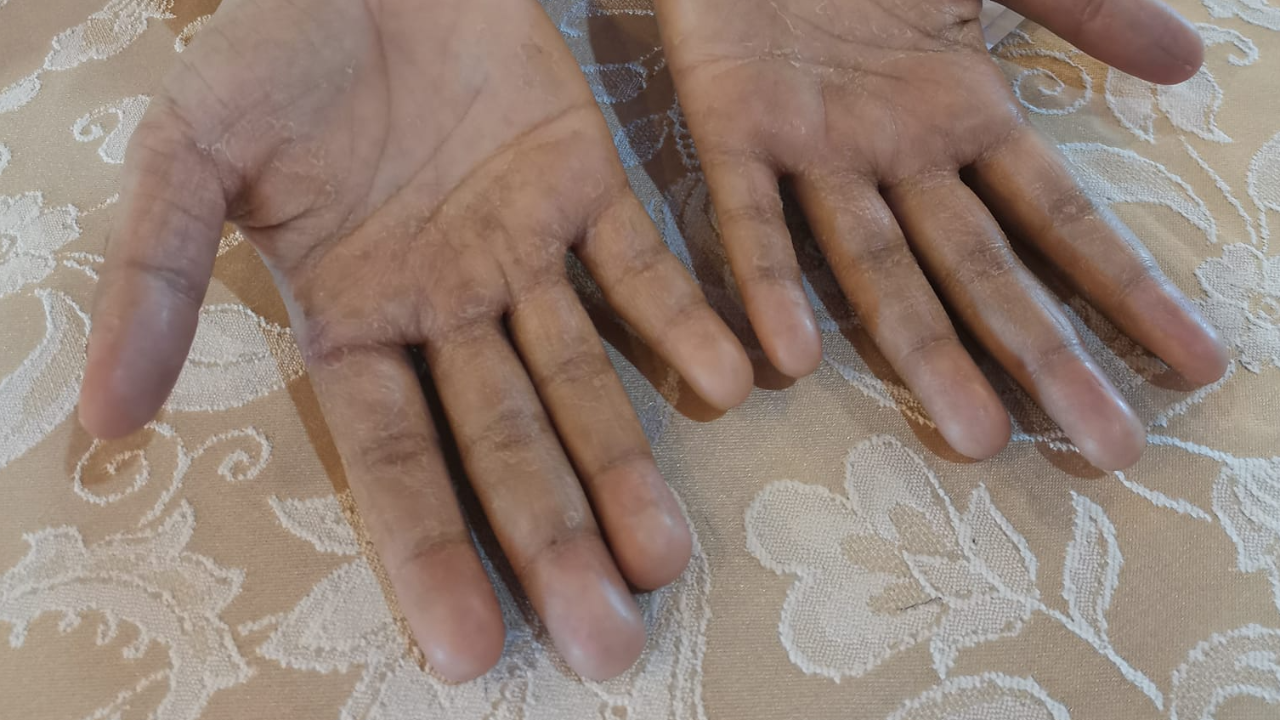 ครูเผยภาพ "มือนักเรียน" มาสอบสัมภาษณ์ ผิวลอก มีรอยดำ แต่มีเบื้องหลังประทับใจ