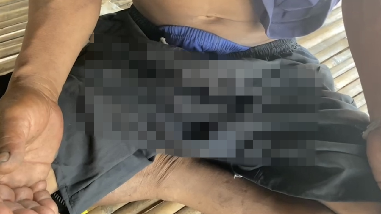 "สยองเลย" เมียฉุนผัวเมา คว้าฉมวกแทงเจ้าโลก-บิด แผลเหวอะ เย็บ 17 เข็ม