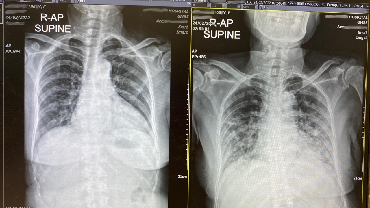 หมอยกเคส ผู้ป่วยสูงอายุ ติดโควิด ไม่เคยรับวัคซีน แม้ได้ยาฟาวิฯ แต่อาการแย่ลง