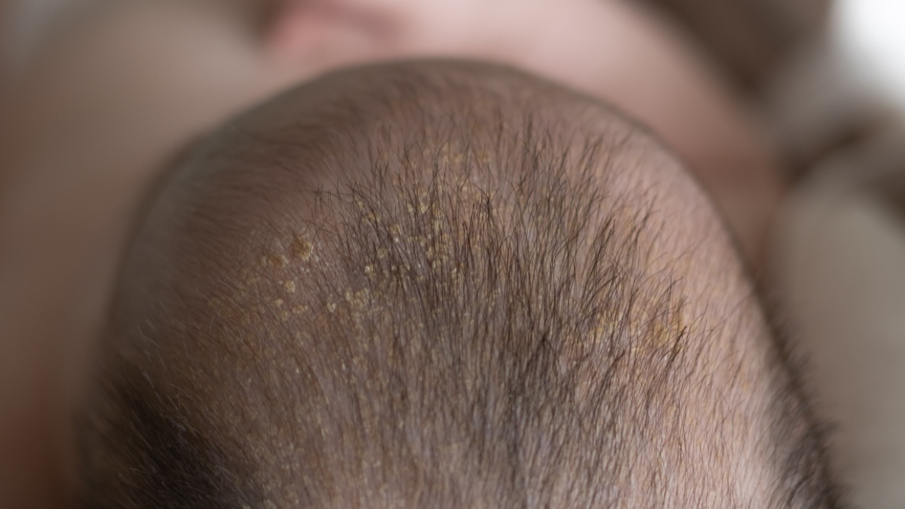 โรคเซ็บเดิร์ม สาเหตุและวิธีการรักษา