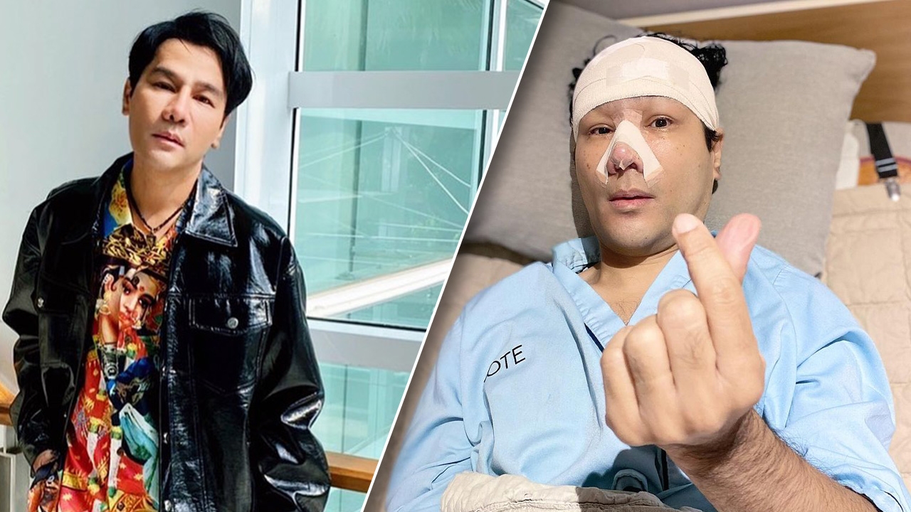 กอล์ฟ เบญจพล เผยภาพล่าสุด หลังไปแก้จมูกที่เกาหลี ทุกอย่างเรียบร้อยดี