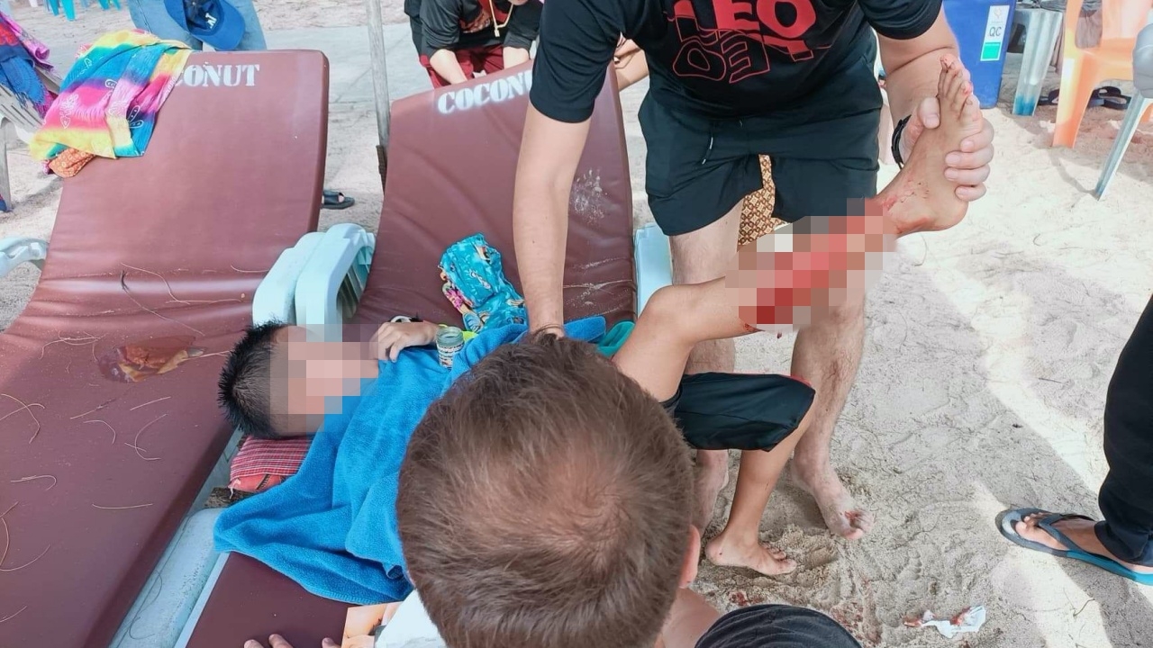 รอยแผลชัด "ฉลาม" กัดขาด.ช.ลูกครึ่งเล่นน้ำหาดกมลา เย็บกว่า 30 เข็ม