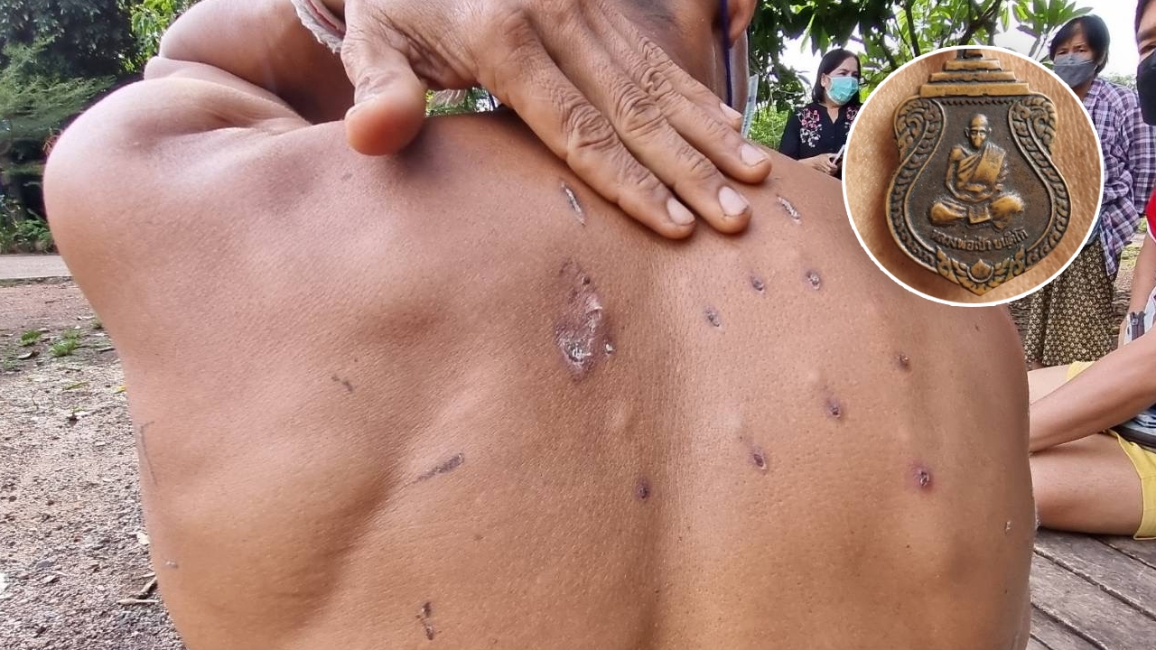 หนุ่มโดนรัวยิงหัว ร่างพรุน รอดตาย เชื่อเป็นเพราะ "เหรียญหลวงพ่อเป้า"