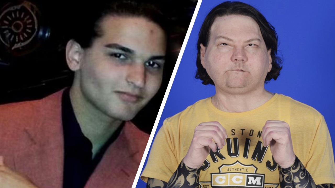 หนุ่มอเมริกันได้รับการผ่าตัดปลูกถ่ายใบหน้าและมือ สำเร็จเป็นรายแรกของโลก