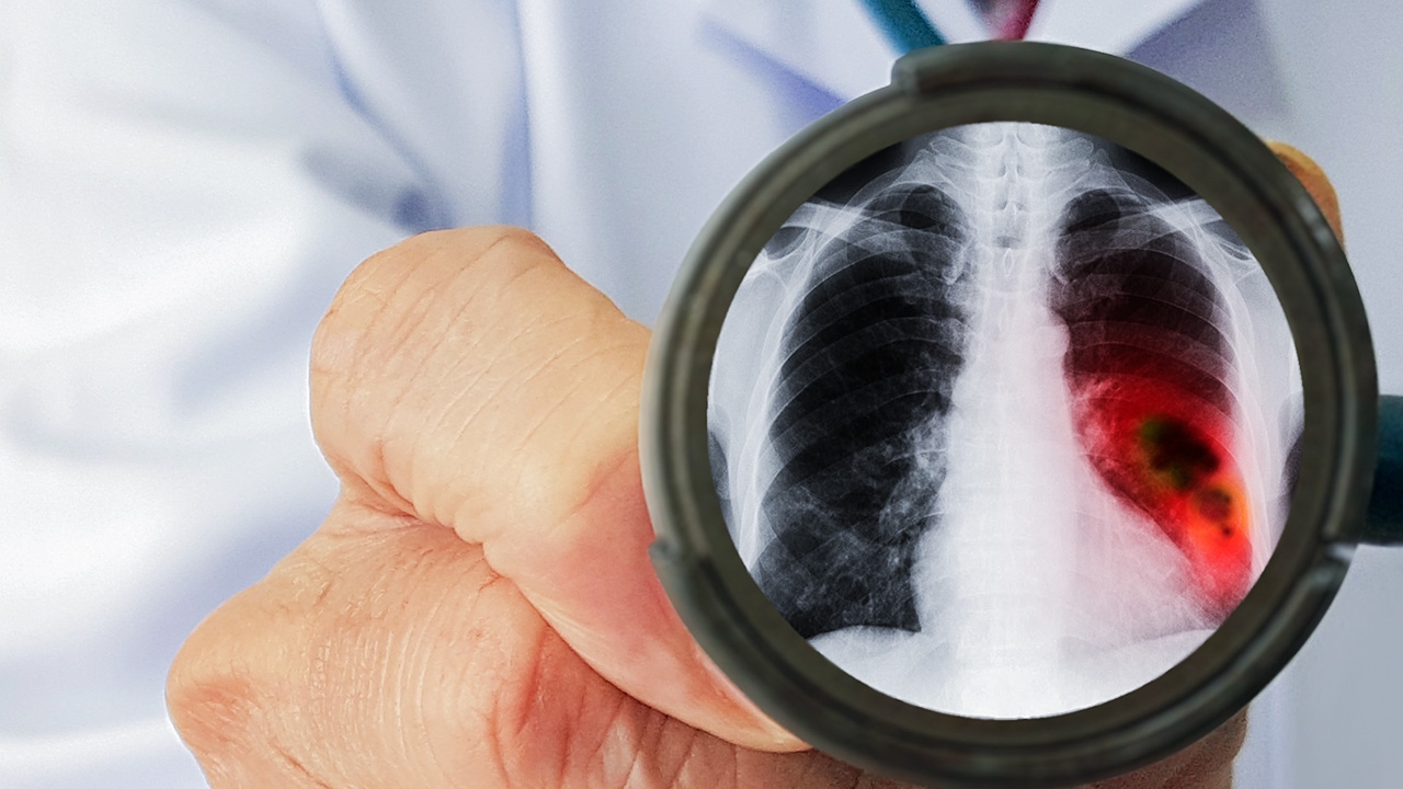 AI CXR Screening ผู้ช่วยคนใหม่ของคุณหมอ คัดกรองผู้ป่วยจากการ X-ray ทรวงอก