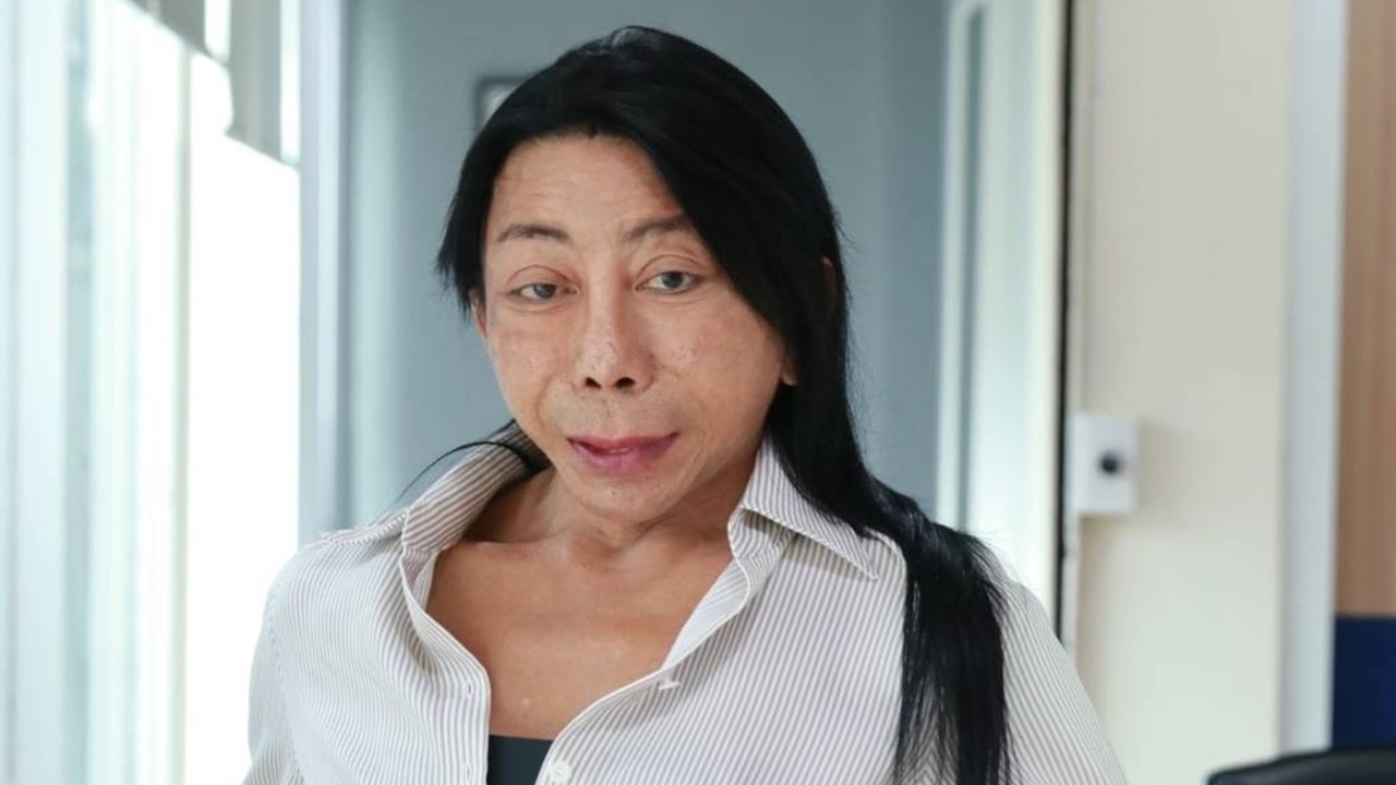 สิตางศุ์ บัวทอง ถลกหนังหัวทำศัลยกรรมปลูกผม ไม่สวยตรงไหนเอาปากกามาวง 