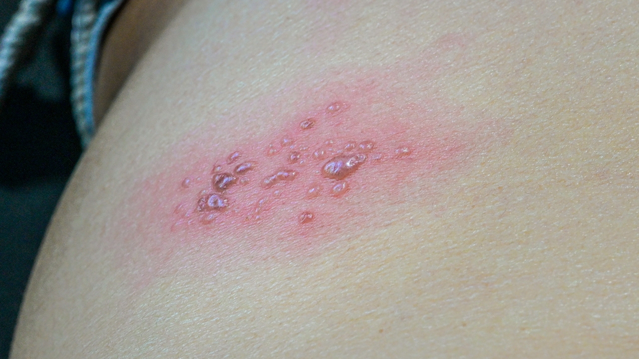 แพทย์ผิวหนัง ชี้วัคซีนโควิด-19 อาจไม่ใช่สาเหตุเกิด "โรคงูสวัด" 