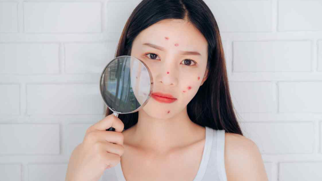 8 วิธี ปราบสิวผิวแพ้มาสก์