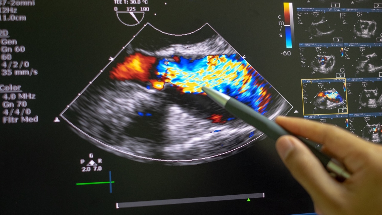 การเปลี่ยนลิ้นหัวใจโดยไม่ต้องผ่าตัด (TAVI)