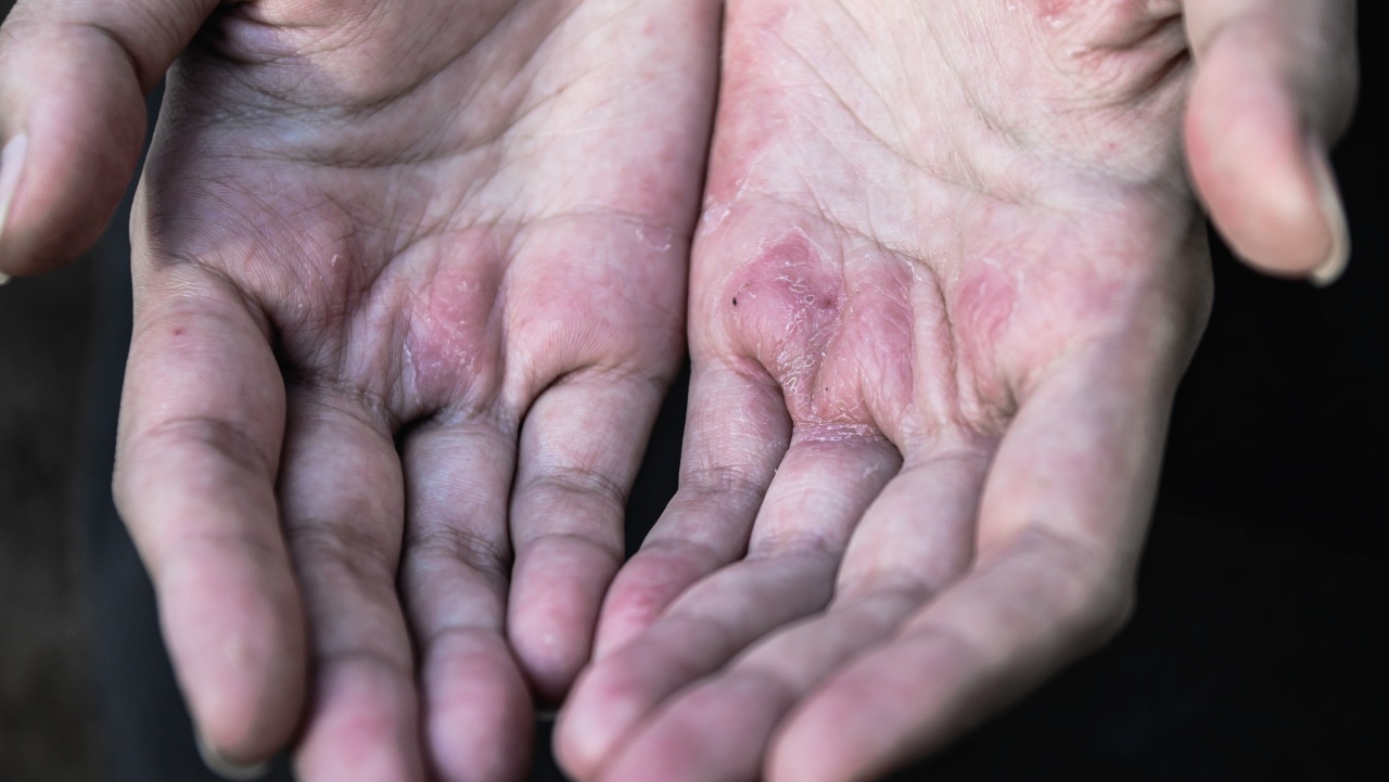 8 โรคผิวหนังผู้สูงอายุที่พบบ่อย เรื่องผิวๆ ของผู้สูงวัย