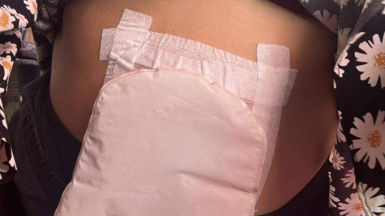 รพ.แจง สาวคลอดลูกแต่ชีวิตพัง แผลไม่สมาน ยันไม่นิ่งดูดาย อยู่ระหว่างการรักษา