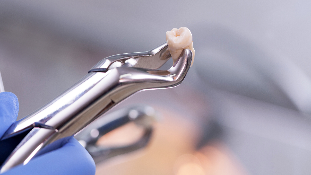 ทันตแพทยสภา แจงถอนฟัน 12 ซี่ดับ พบติดเชื้อในกระแสเลือด สั่งสอบข้อเท็จจริง 