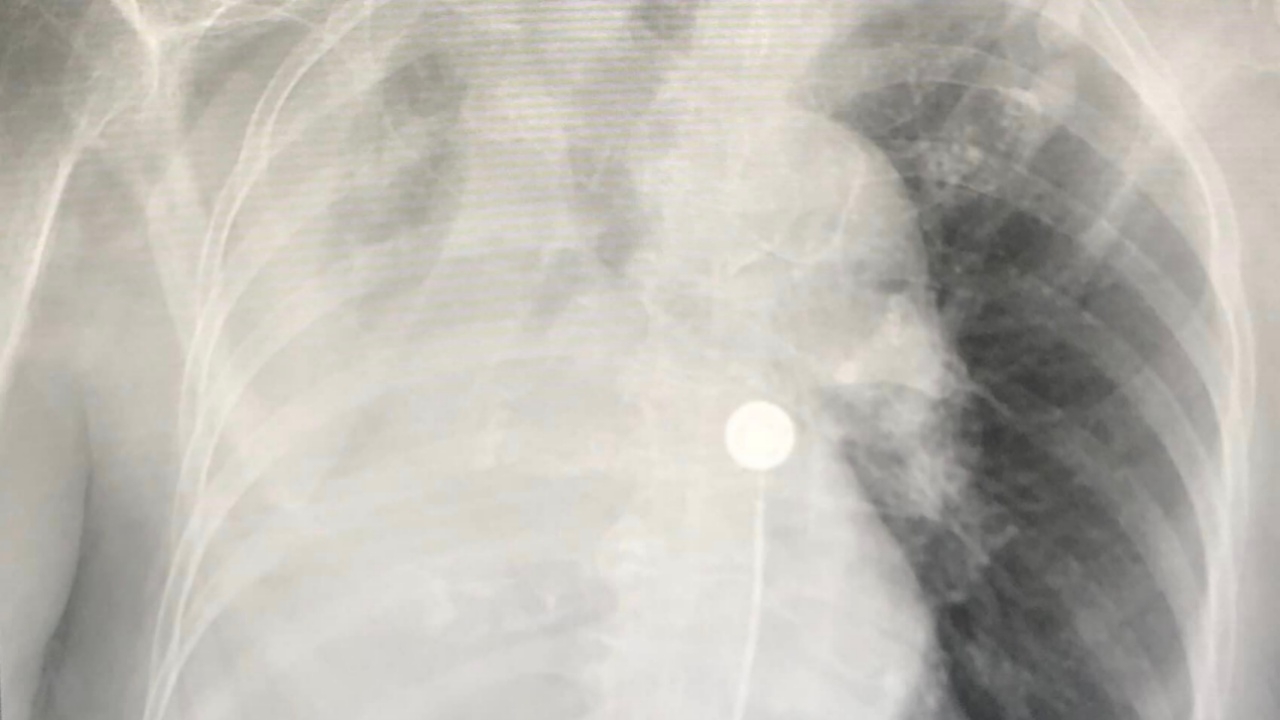 เจอ 2 รายแล้ว ผู้สูงอายุติดโควิด-19 หลอดลมอุดตัน ปอดแฟบทั้งข้าง สุดท้ายเสียชีวิต