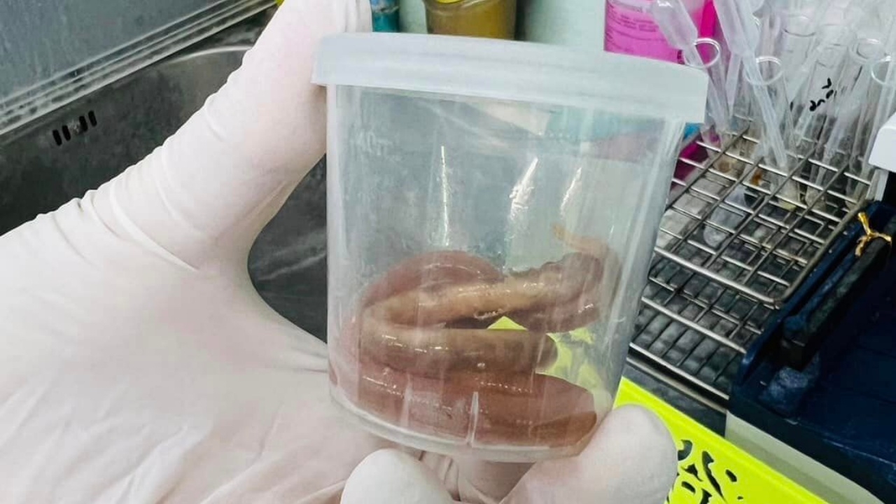 หญิงท้องวัย 27 ปี คลื่นไส้รุนแรง อาเจียนออกมา พบพยาธิไส้เดือน 2 ตัว