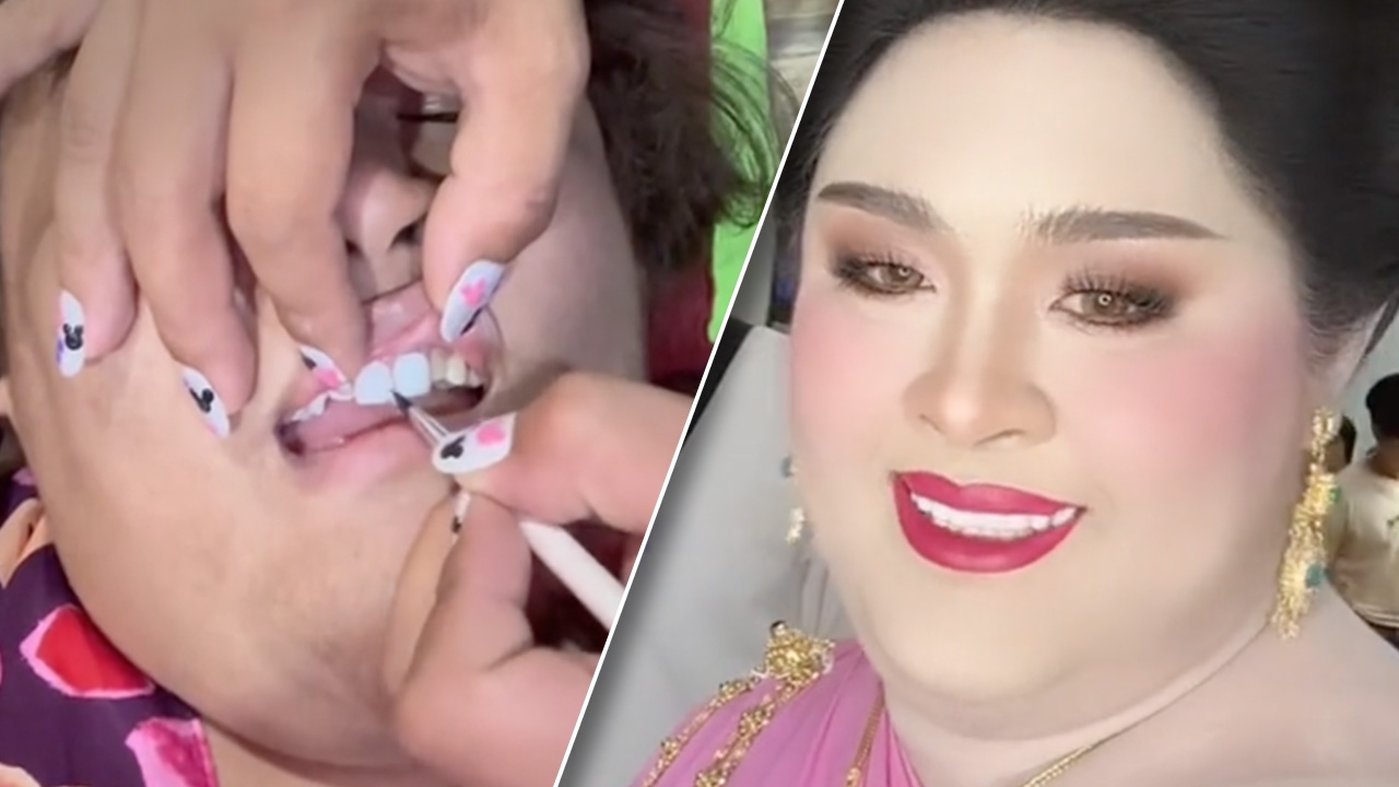 ฟันสวยด้วยมือเรา ผู้เข้าประกวดธิดาช้าง ใช้เล็บปลอมติดฟัน (คลิป)