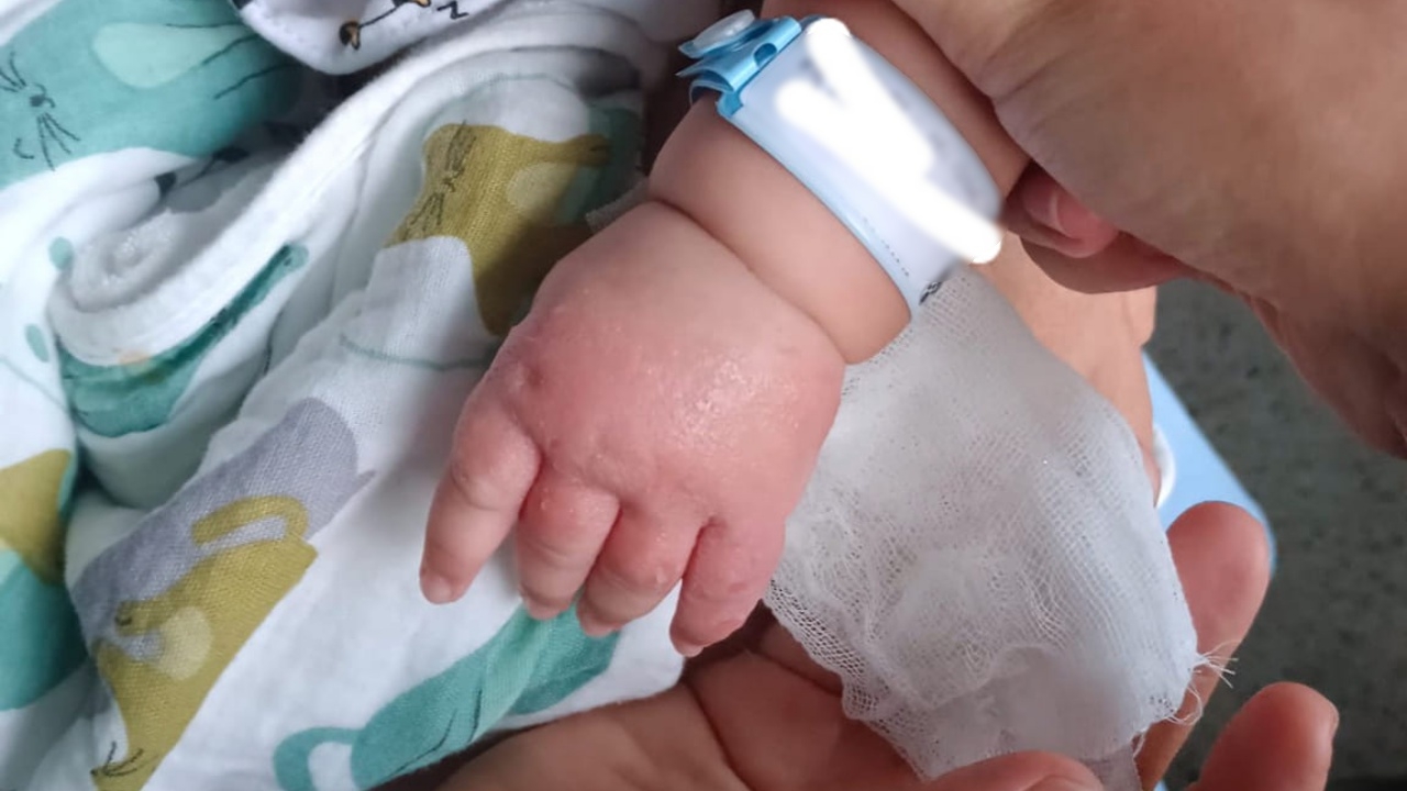 ฟังสองมุม ปมแม่เด็กโวยโรงพยาบาล อ้างเจาะน้ำเกลือลูกชายวัย 4 เดือน จนมือติดเชื้อ