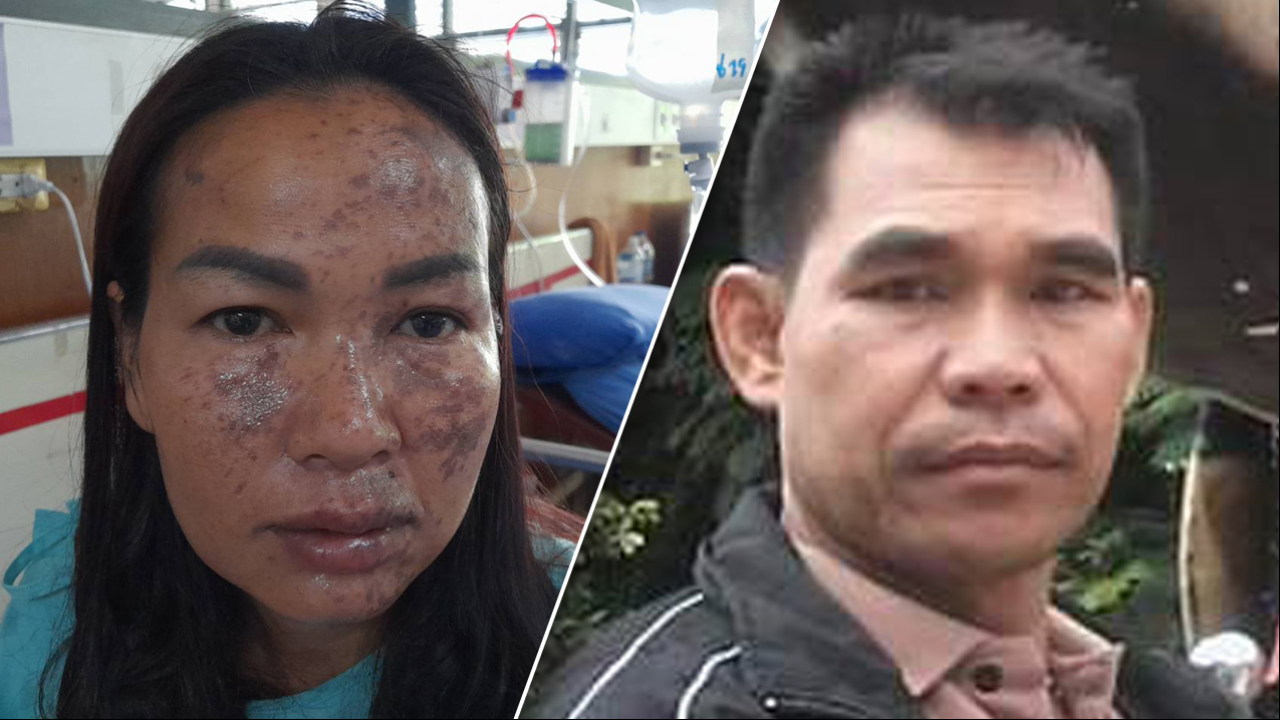 บุกสาดน้ำกรดเมียเก่า หนุ่มคนใหม่โดดบัง โดนเต็มๆ สาหัส