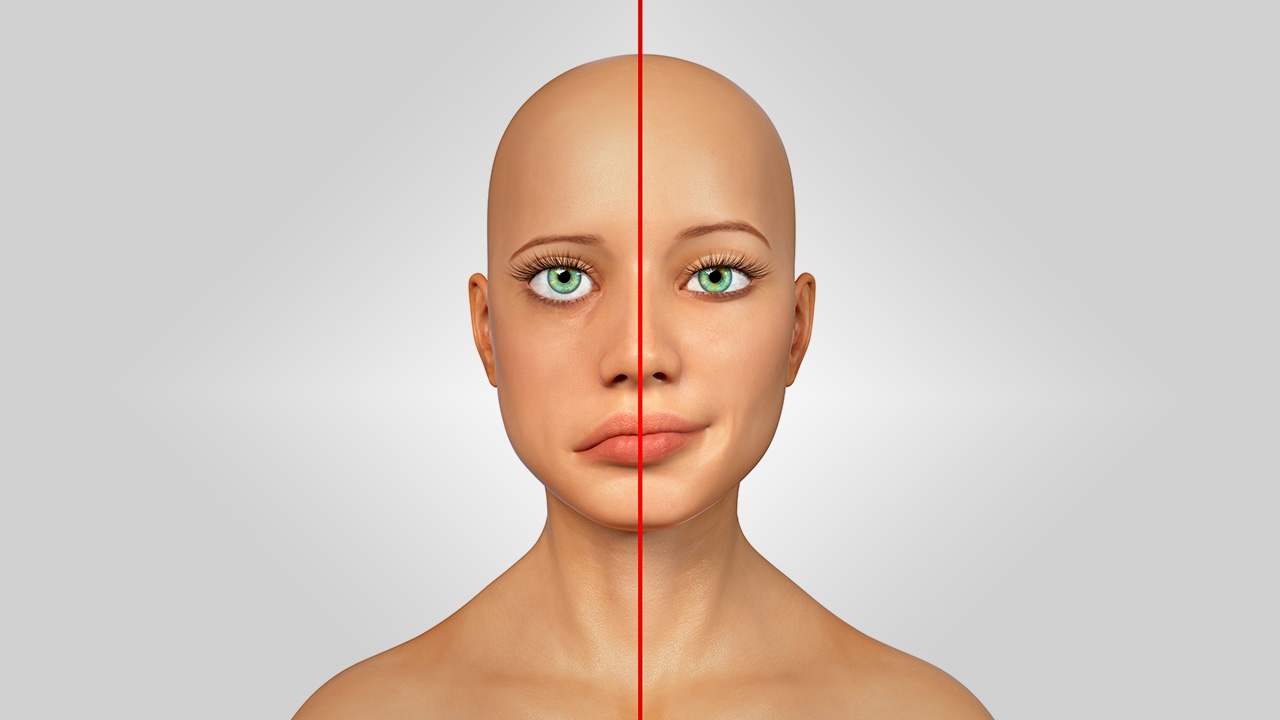 รู้จัก..รัมเซย์ ฮันต์ ซินโดรม อาการหน้าเบี้ยวครึ่งซีก